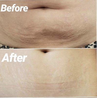 Non surgical tummy tuck