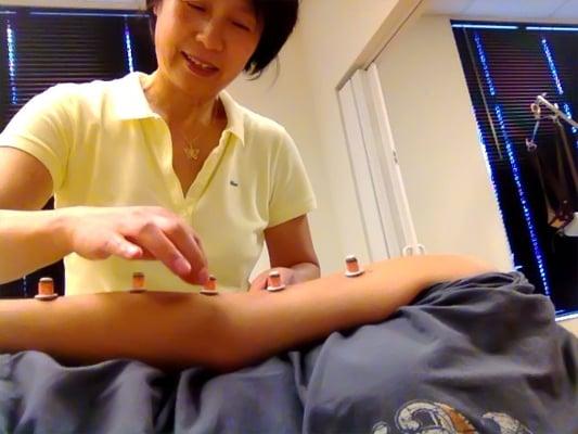 Helen Hu, LAc applying MOXA, the alternate heating and pressing on acupoint without the use of needles.
