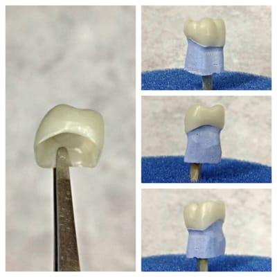 Zirconia Crown