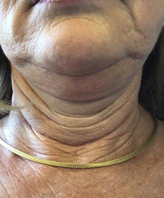 Dr Anderson failed at Neck and Jowl lift.