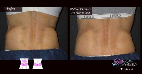 CoolSculpting
