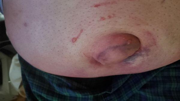 is this the way a hernia is suppose to look like after surgery? It still looks like the hernia is still there. and I am still in severe pain