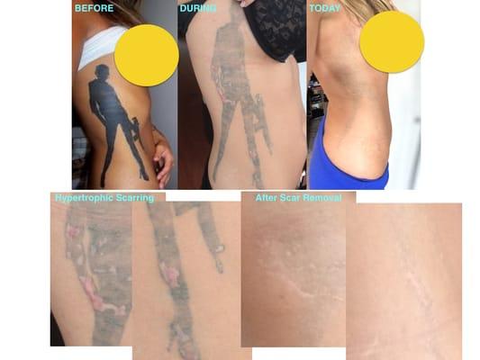 Side Tattoo progress