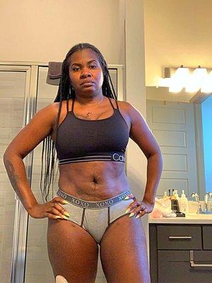 This is my stomach after Dr Cortes 11k later!