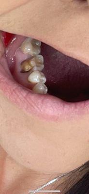 One of 3 teeth he drilled like this. Do NOT go to him for ANYTHING!!