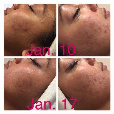 She came to me last week for a facial, did the home care, came back today for a follow up and we were both blown away!