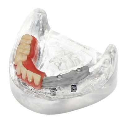 AvaDent Digital Dentures