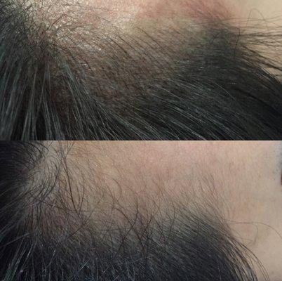 Hairline microblading