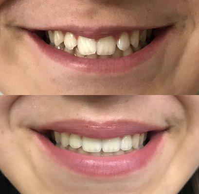 Before and after braces. One year treatment. Beautiful smile/ gorgeous new lips and a very happy patient.