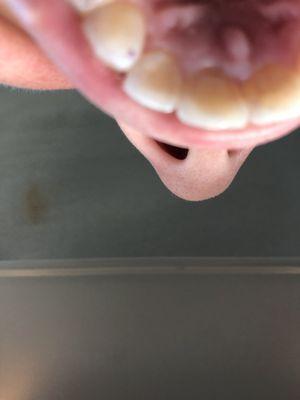 The tooth in the center was completely black I. The back when I first went in.