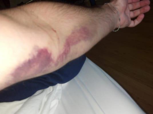 My friend went in to get his blood drawn, and this is what he was left with. more in my review.