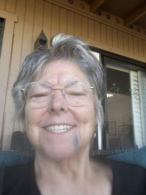 My mouth 10 hours after lower jaw implants done.