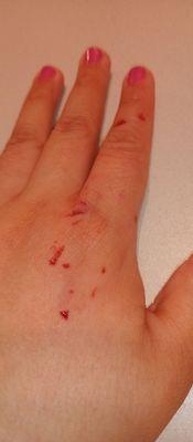 Had blood on my shirt because my blood kept flowing throughout the night from one of the finger wounds. Photo after going to a doctor.