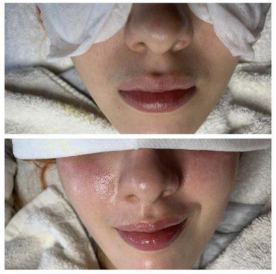 New client facial before and after