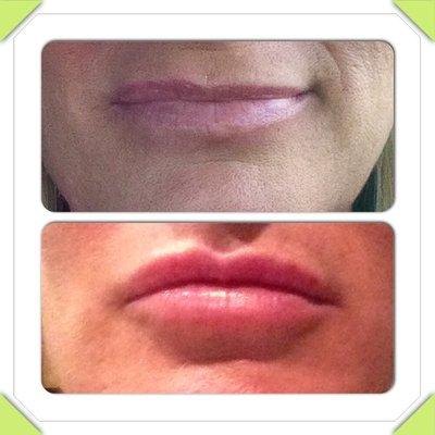 Before and after lip filler.