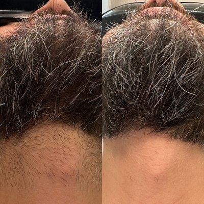 LL Infinity Skin Body & Laser