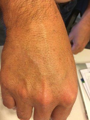 AFTER 2 TREATMENTS FOR TREATING SOLAR DAMAGE