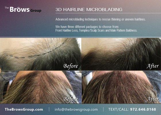 We recreate your hairline stroke by stroke, reclaiming what has been lost and giving the appearance of lush, healthy hair.