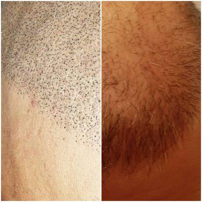 Before And After 56 year old guy with bad hair transplant.
