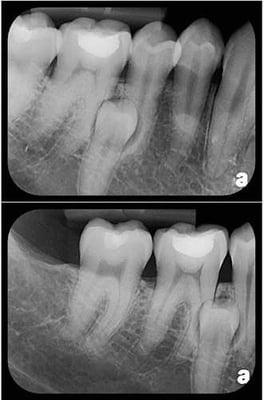 A photo of my rare, dormant pre-molar that Dr. Rosencrantz emailed to me