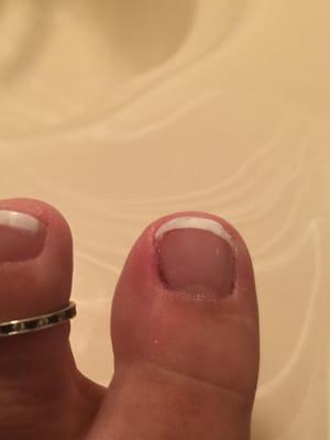 It bled and now swollen.