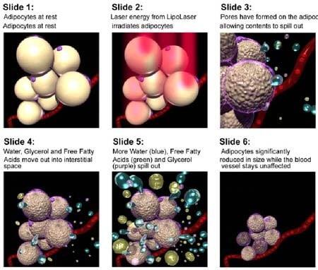 During each treatment, the Lipo Laser energy safely penetrates your skin at a wavelength targeted for adipose cells.