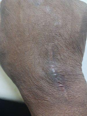 A procedure that Dr Richard Done to relieve pain from my wrist by removing partial bone.