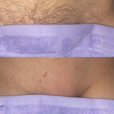 Brazilian Sugar Wax (small hairs were chosen not to be plucked)