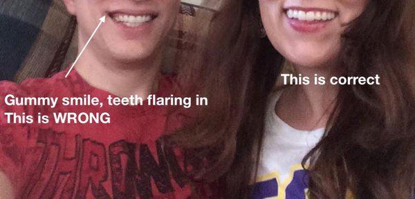 This is the result of their work: me on the left and how they misaligned my bite, and my relative on the right.