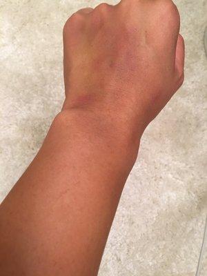 6 days post getting blood drawn