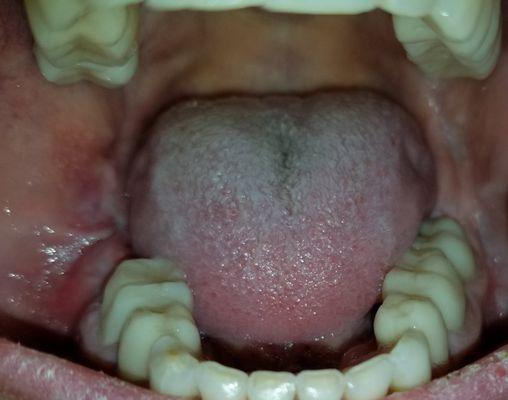 cheek was sutured to my gum.