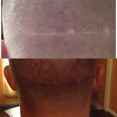 Hair transplant scar fixed with Micro Hair by Jem