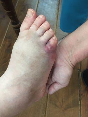 My sister's foot. Broken by blunt force trauma and finger print bruising on her legs where someone grabbed her