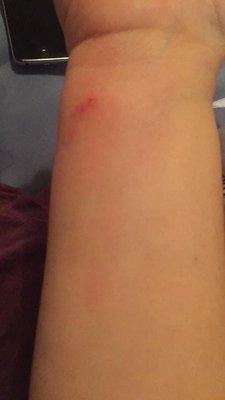 bedbug bites just the wrist there were other locations