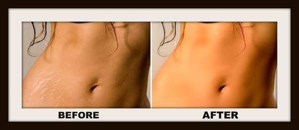 Stretch Marks Before and After
