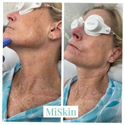 Aerolase laser by - MiSkin