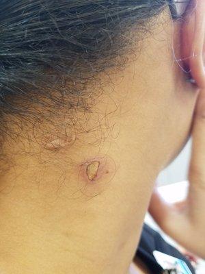 Burn after 5 days. She had the nerve to tell me that I had ALLERGIES and that's what caused this. DO NOT GO THERE.