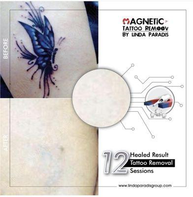 Body tattoo removal with colored ink.