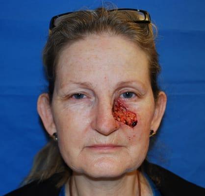 Skin Cancer Reconstruction. 55 year old woman with a squamous cell carcinoma excised by a MOHS dermatologist and referred to me for repair.