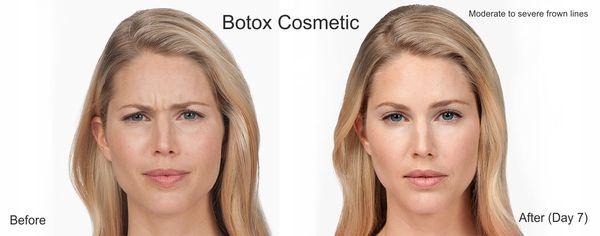 Cosmetic Botox