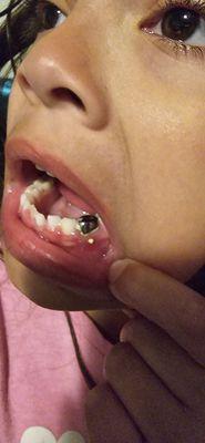 This is the hole in my daughters jaw. Where it continues to leak, whatever it is that they squeeze inside of a root canal to fill it.