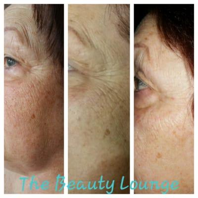 Before, during & after 6 peels!