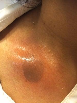 This is what happened to me after getting facial from this place due to the negligence of the staff.