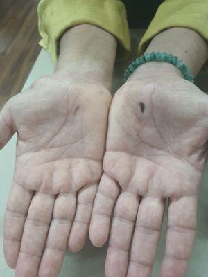 Carpal Tunnel Express