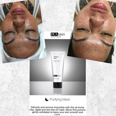 Facial using Purifying Mask with pumice!! Leaving your skin soft and smooth!