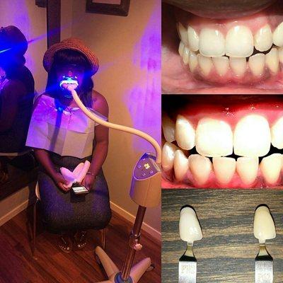 Client brighten her smile by 6 shades!