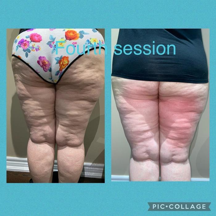 Pearls Body Contouring