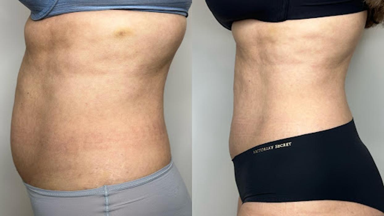 TS Browshes Esthetics and Laser