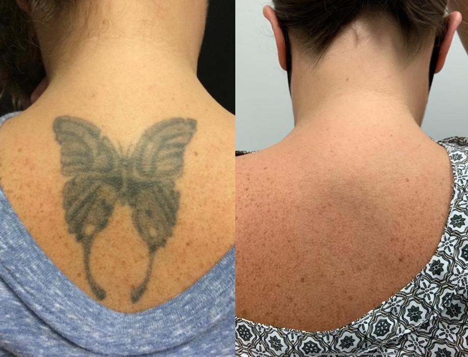 Removery Tattoo Removal & Fading