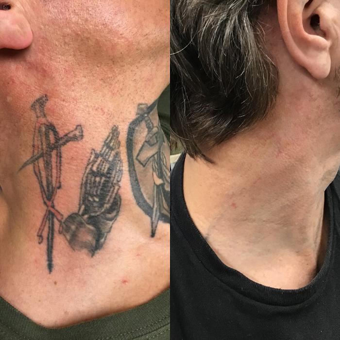 Removery Tattoo Removal & Fading